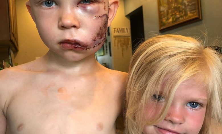 A boy gets badly wounded in the face while saving his little sister from a dog attack A boy gets badly wounded in the face while saving his little sister from a dog attack