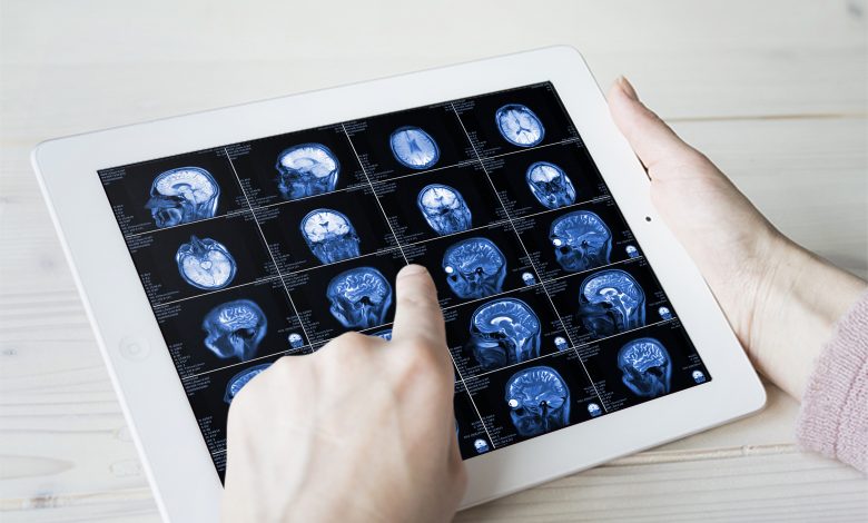 Qatari Stroke Research Published in International Scientific Journal Qatari Stroke Research Published in International Scientific Journal