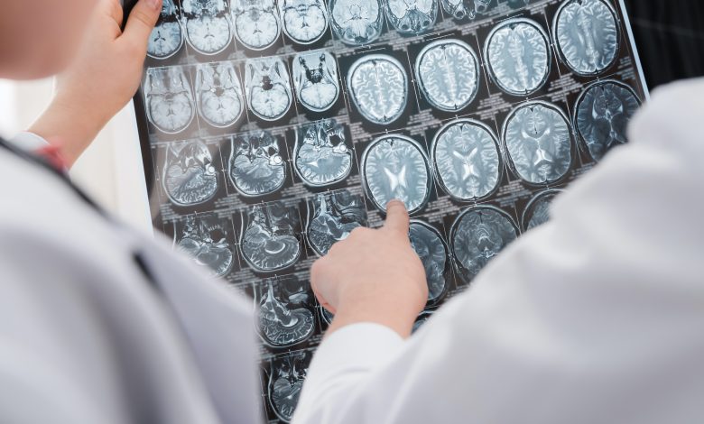 Can our brain age differ due to a Coronavirus infection? Can our brain age differ due to a Coronavirus infection?