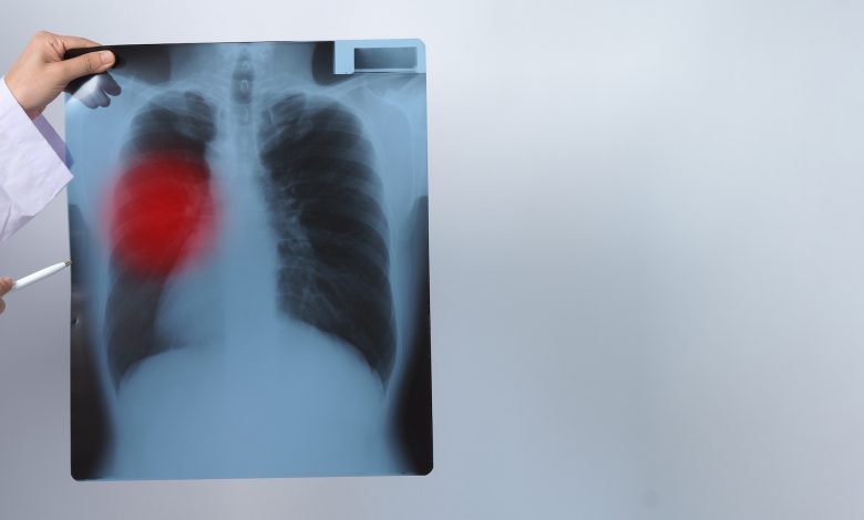 Scientists identify protein that causes lung cancer Scientists identify protein that causes lung cancer