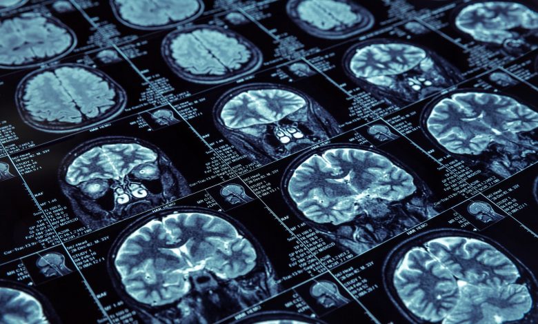 Scientists discover four types of Alzheimer's Scientists discover four types of Alzheimer's